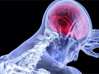 High Impact Articles on Traumatic Intracranial Hypertension
