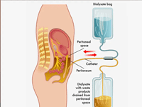 Scholarly Peer-Review Journal on Peritoneal Dialysis