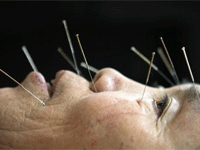 Online Databases on Acupuncture